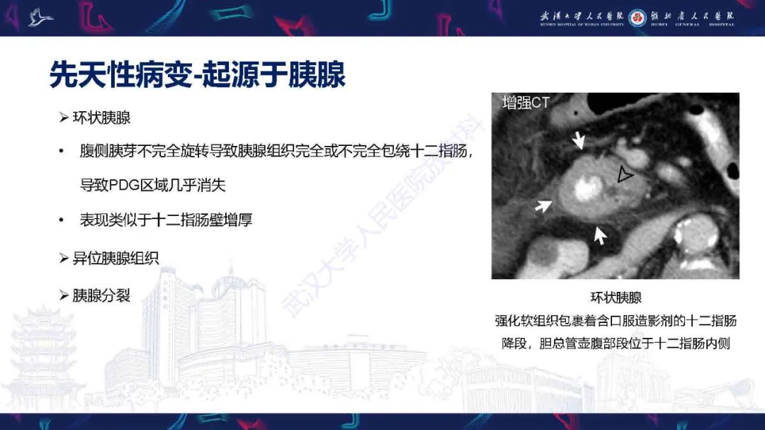 影像PPT - 【PPT】胰十二指肠沟病变影像诊断-27