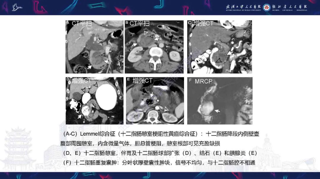 影像PPT - 【PPT】胰十二指肠沟病变影像诊断-29