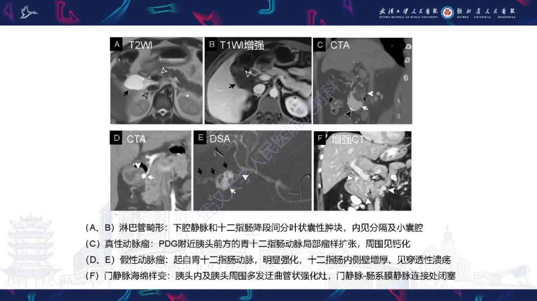 影像PPT - 【PPT】胰十二指肠沟病变影像诊断-32