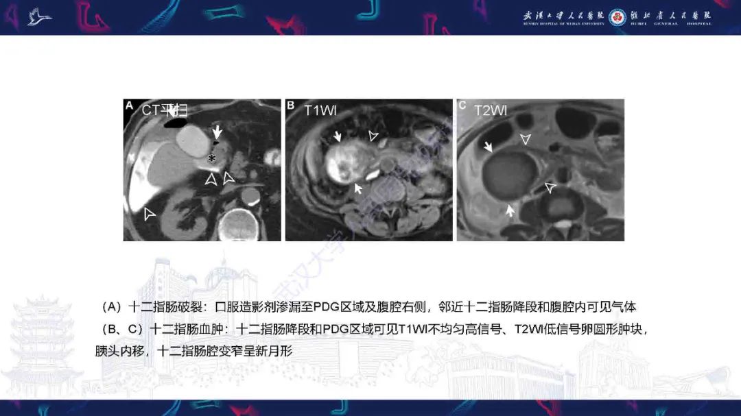 影像PPT - 【PPT】胰十二指肠沟病变影像诊断-34