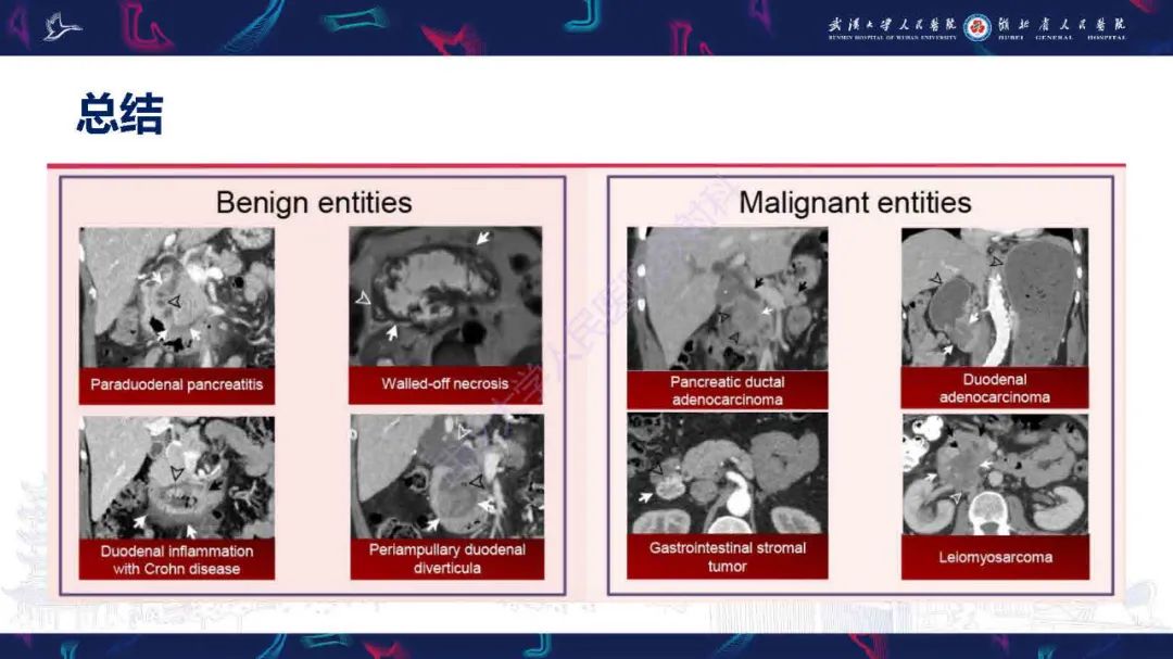 影像PPT - 【PPT】胰十二指肠沟病变影像诊断-37