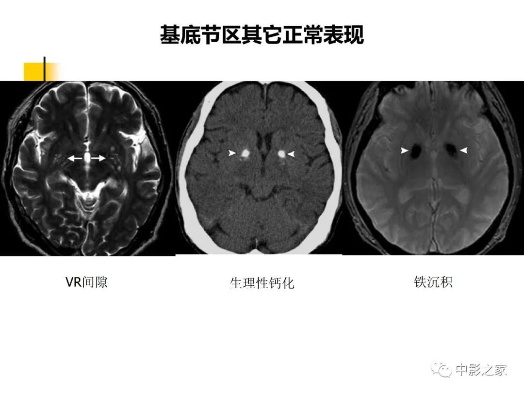 影像PPT - 【PPT】双侧基底节、丘脑病变影像学表现-7
