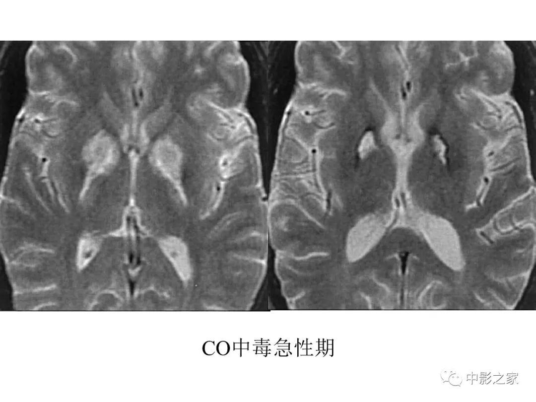 影像PPT - 【PPT】双侧基底节、丘脑病变影像学表现-13