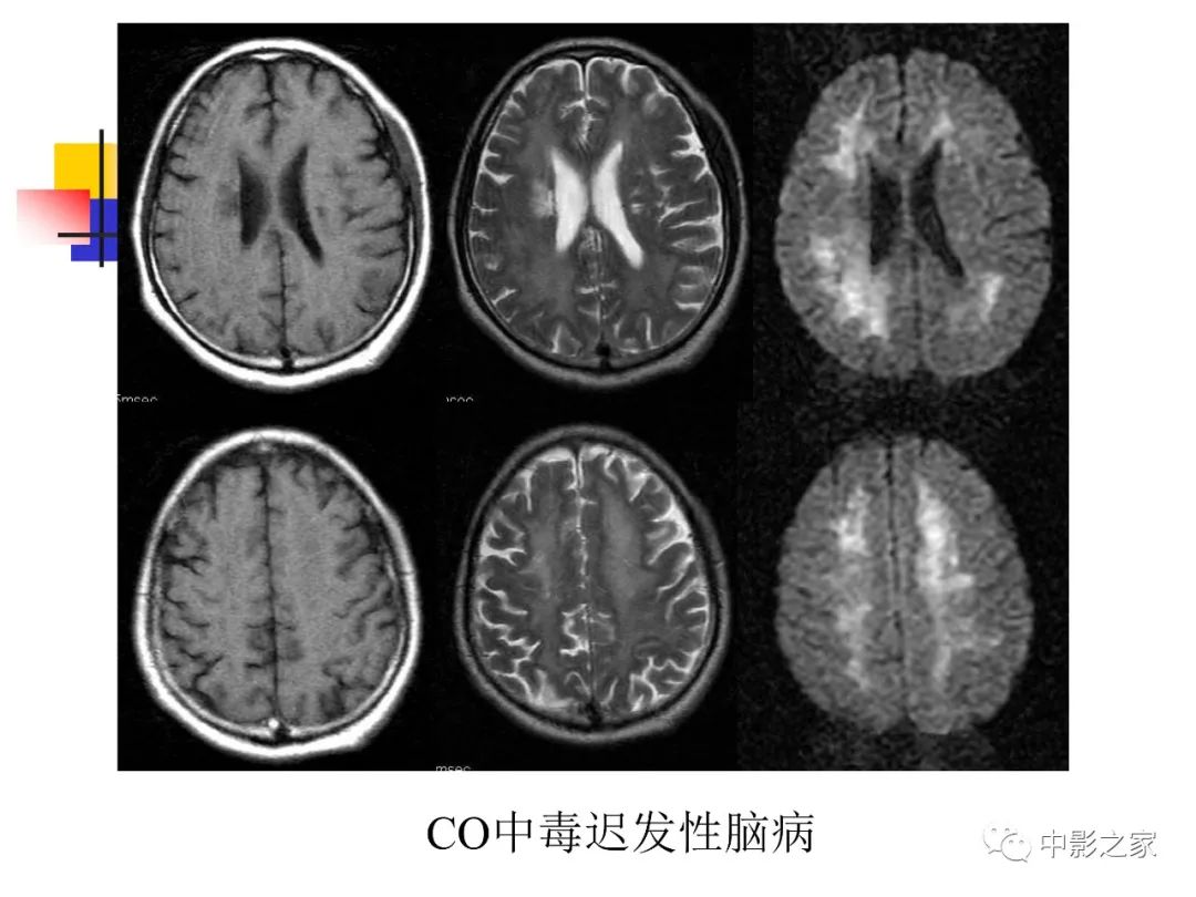 影像PPT - 【PPT】双侧基底节、丘脑病变影像学表现-14