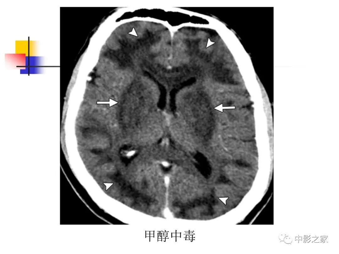 影像PPT - 【PPT】双侧基底节、丘脑病变影像学表现-15