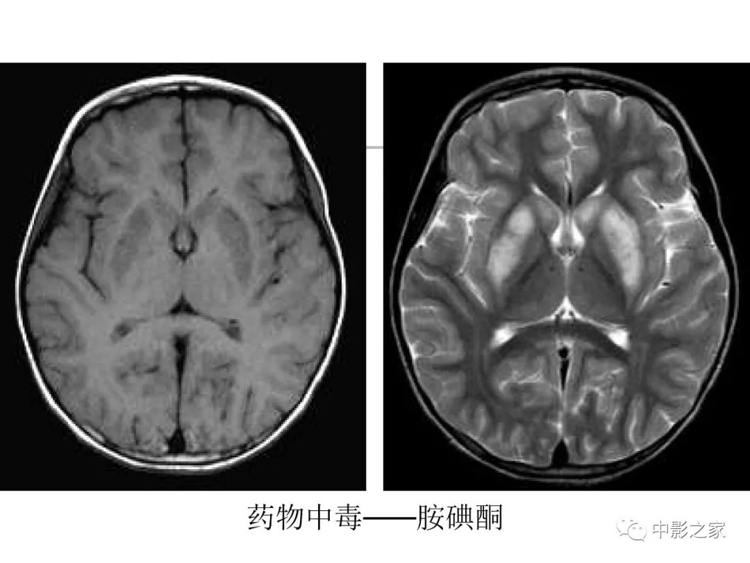 影像PPT - 【PPT】双侧基底节、丘脑病变影像学表现-16