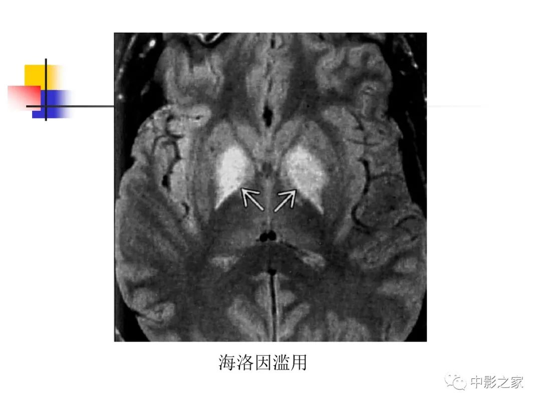 影像PPT - 【PPT】双侧基底节、丘脑病变影像学表现-17