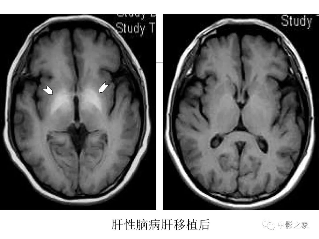 影像PPT - 【PPT】双侧基底节、丘脑病变影像学表现-19