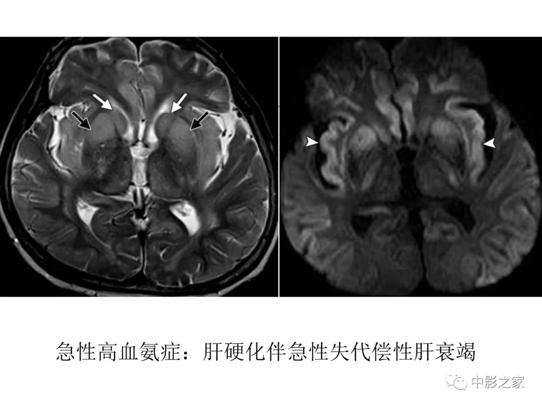 影像PPT - 【PPT】双侧基底节、丘脑病变影像学表现-20