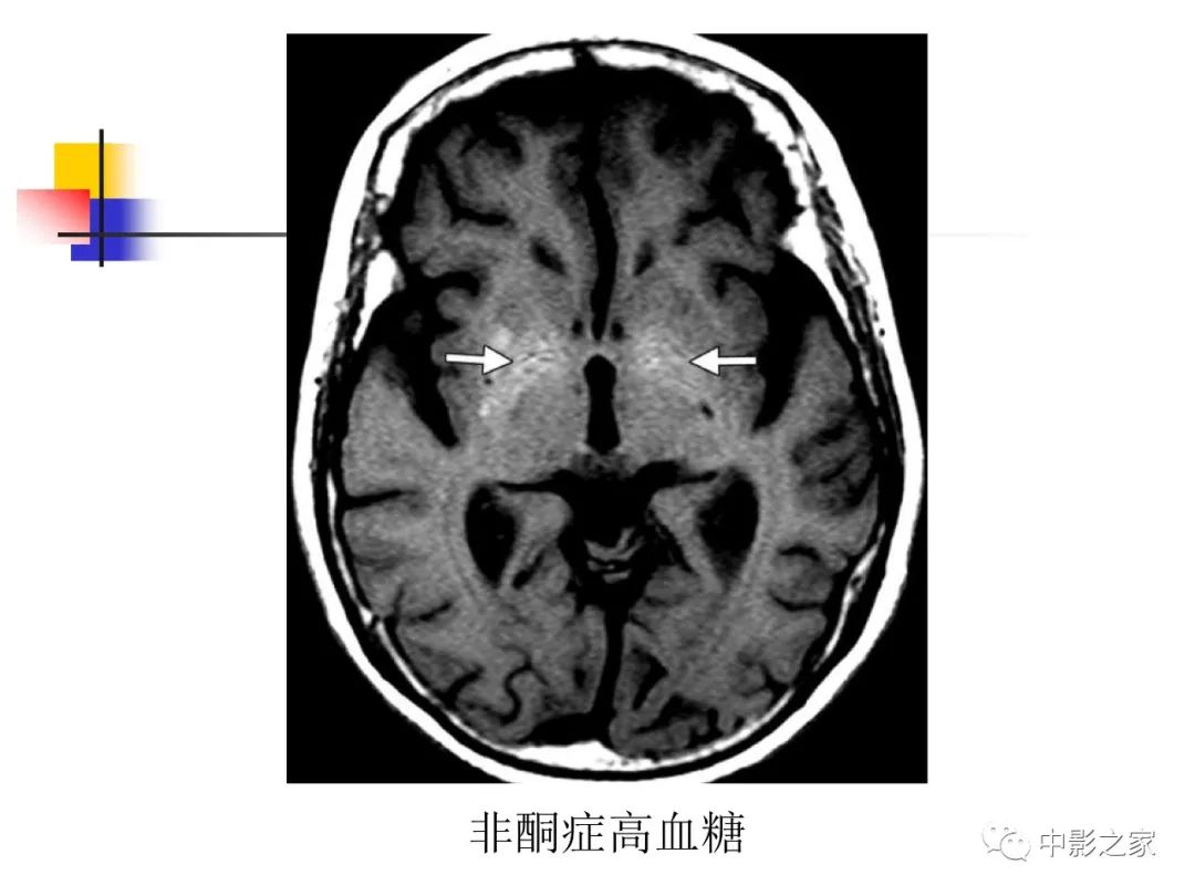 影像PPT - 【PPT】双侧基底节、丘脑病变影像学表现-22