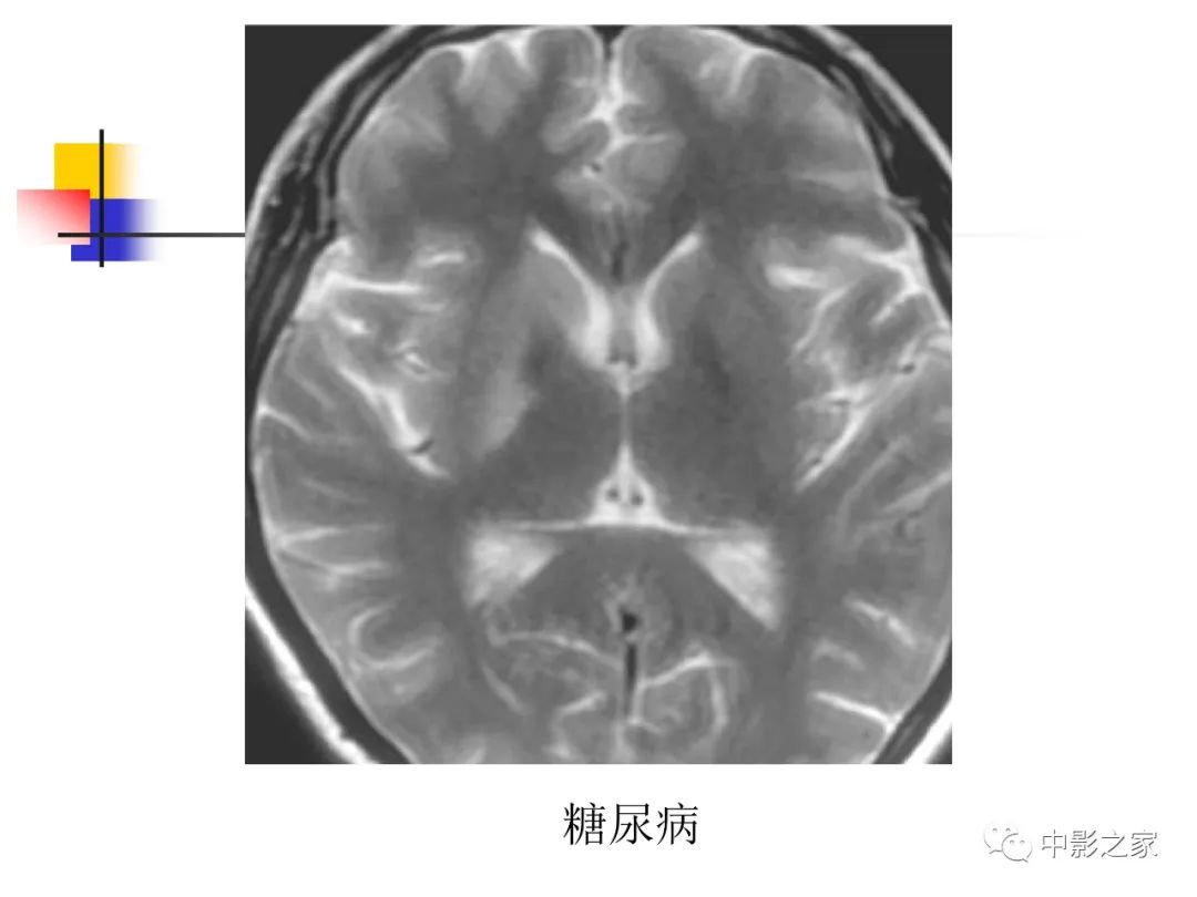 影像PPT - 【PPT】双侧基底节、丘脑病变影像学表现-23