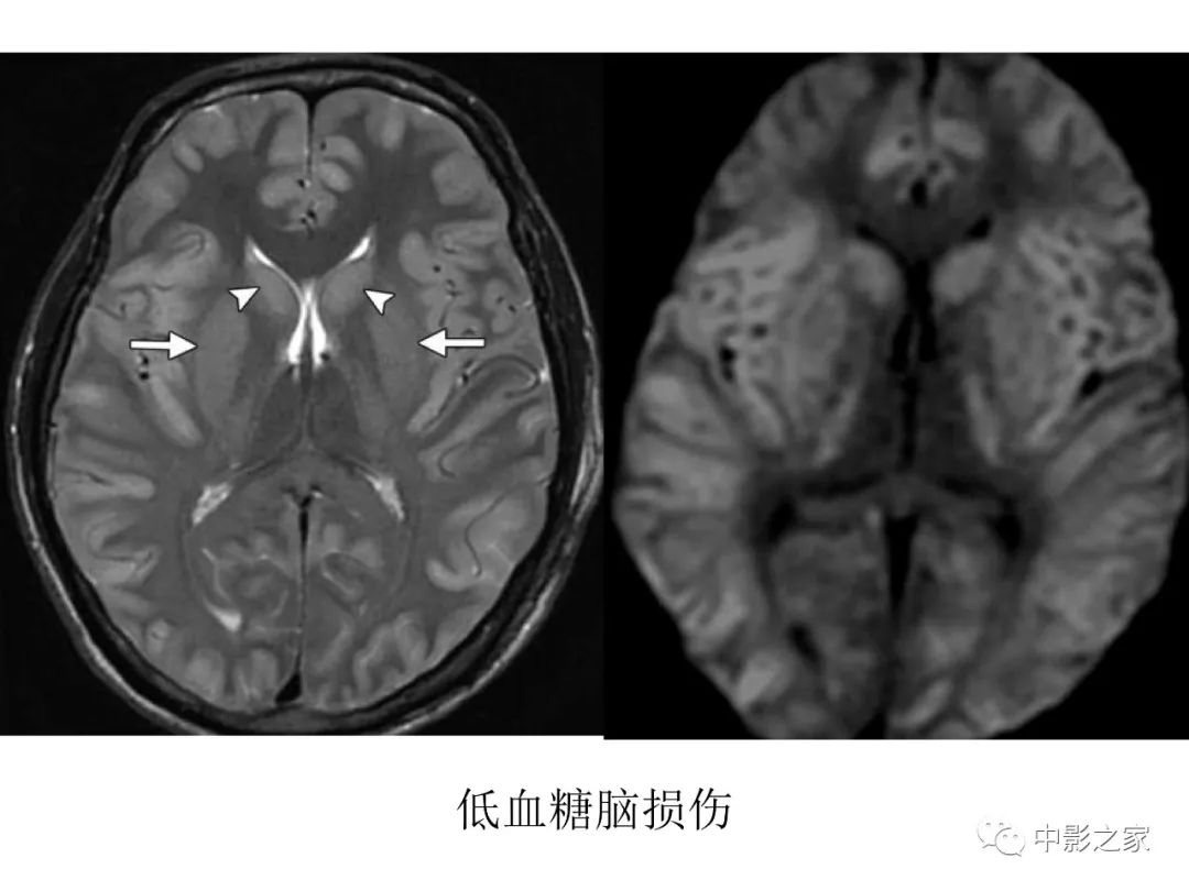 影像PPT - 【PPT】双侧基底节、丘脑病变影像学表现-25