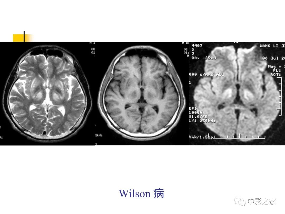 影像PPT - 【PPT】双侧基底节、丘脑病变影像学表现-33