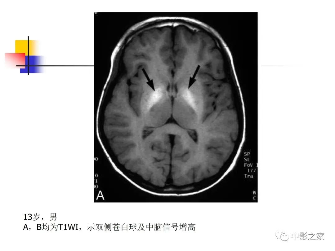 影像PPT - 【PPT】双侧基底节、丘脑病变影像学表现-34