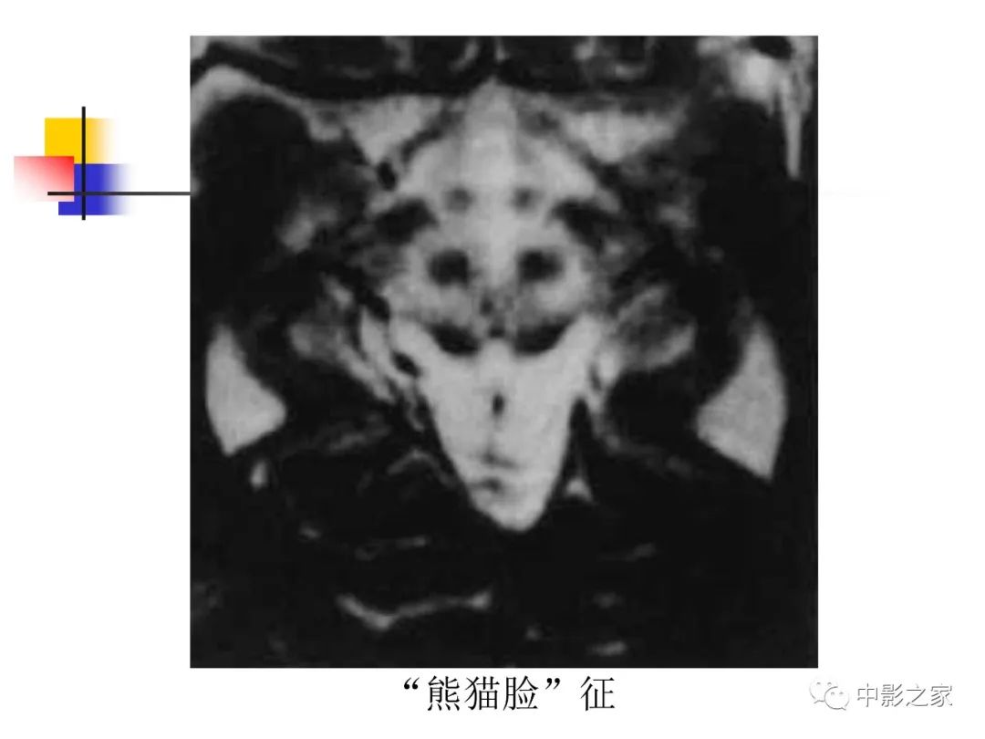 影像PPT - 【PPT】双侧基底节、丘脑病变影像学表现-35