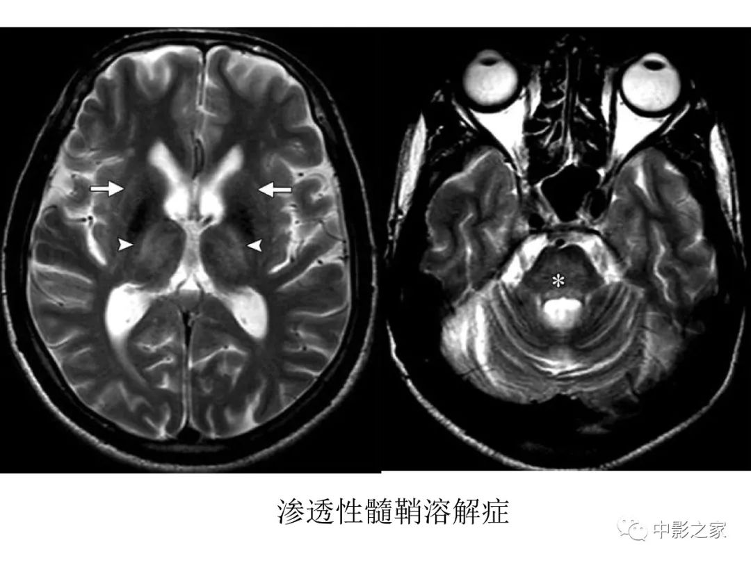 影像PPT - 【PPT】双侧基底节、丘脑病变影像学表现-37