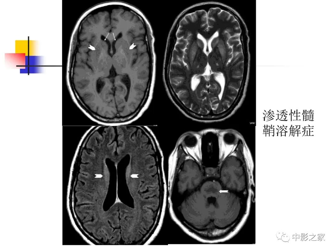 影像PPT - 【PPT】双侧基底节、丘脑病变影像学表现-38