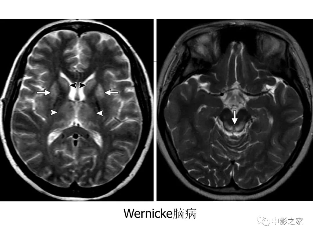 影像PPT - 【PPT】双侧基底节、丘脑病变影像学表现-41