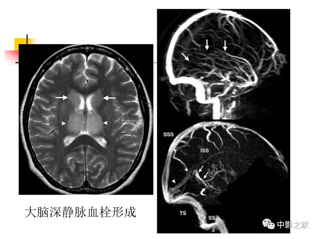 影像PPT - 【PPT】双侧基底节、丘脑病变影像学表现-52