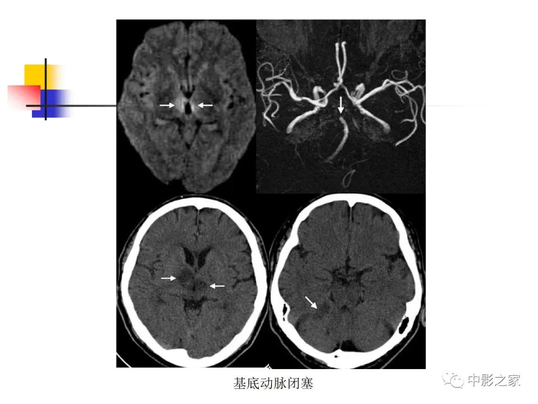 影像PPT - 【PPT】双侧基底节、丘脑病变影像学表现-54