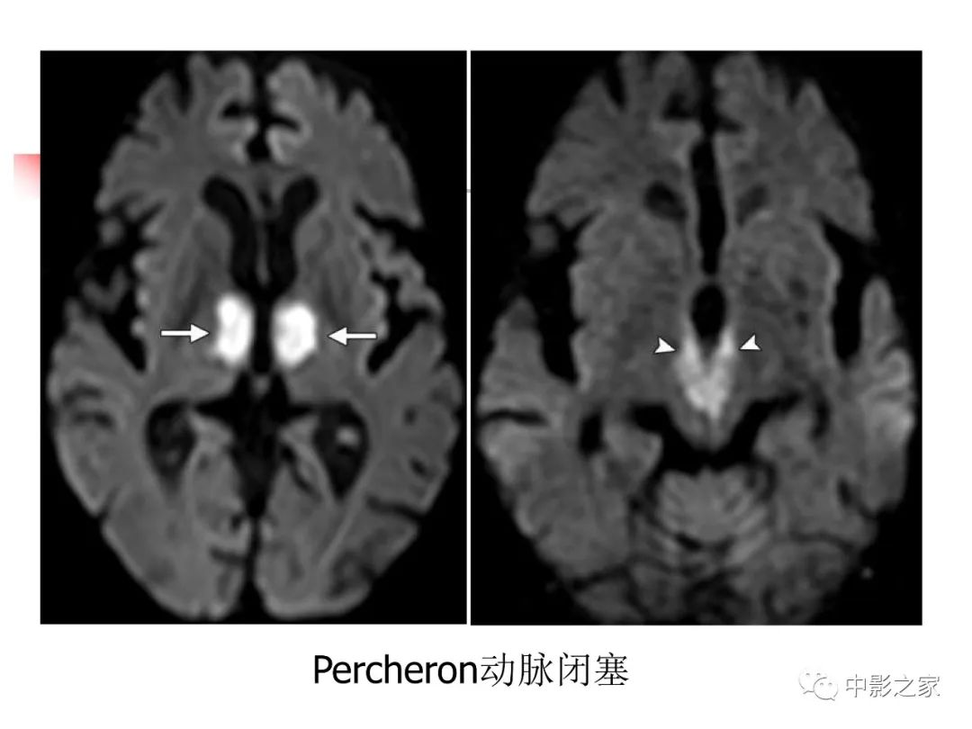 影像PPT - 【PPT】双侧基底节、丘脑病变影像学表现-55
