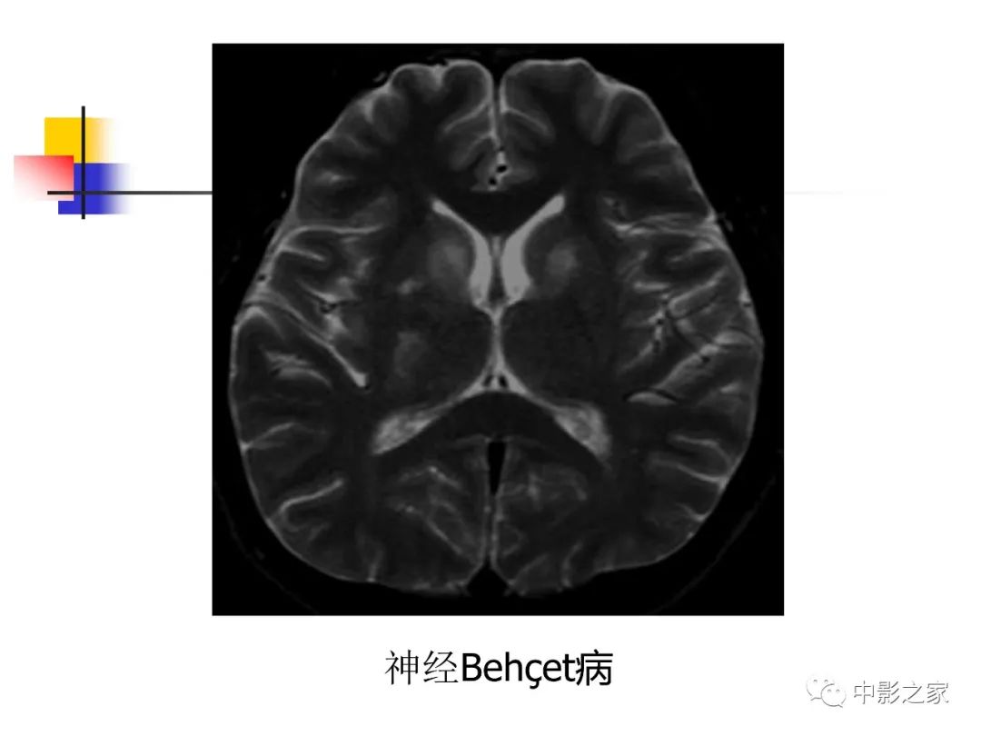 影像PPT - 【PPT】双侧基底节、丘脑病变影像学表现-57