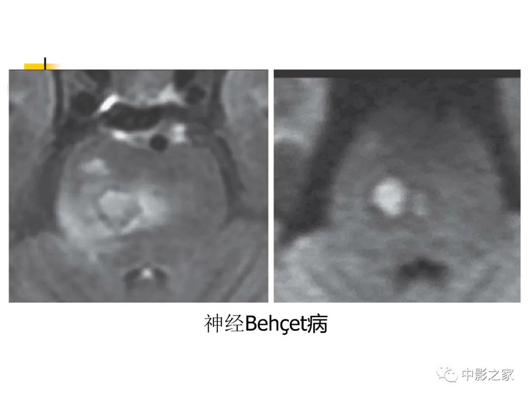 影像PPT - 【PPT】双侧基底节、丘脑病变影像学表现-58