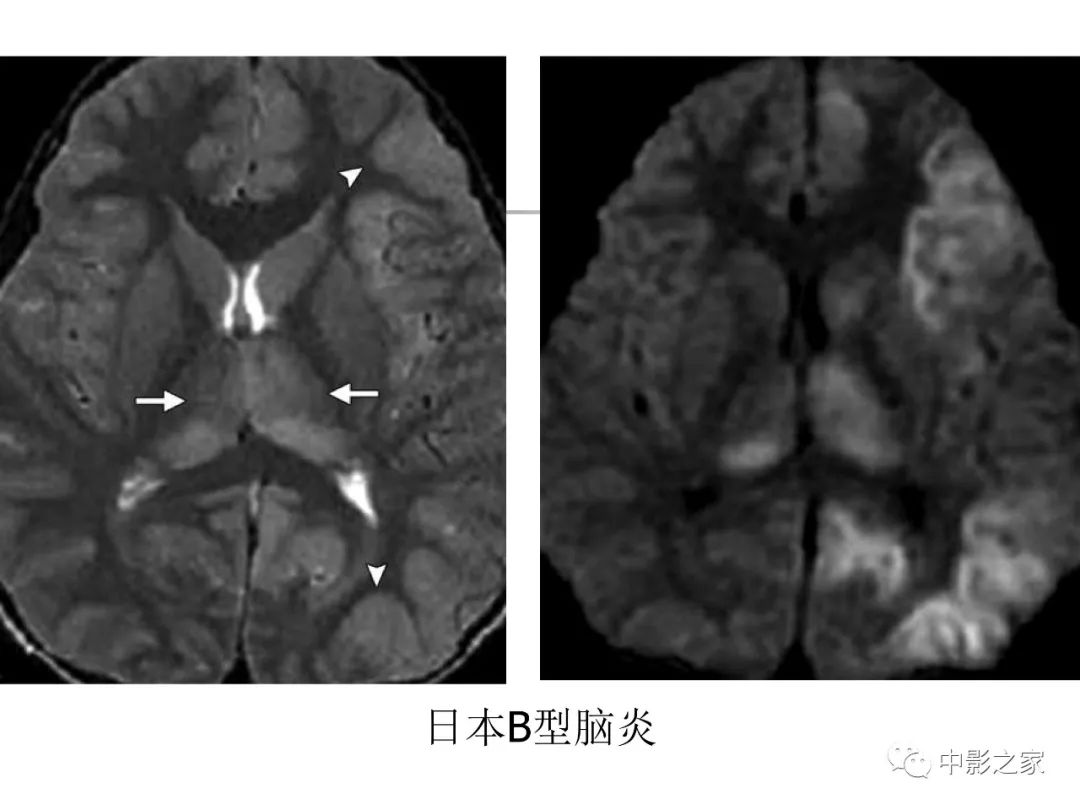 影像PPT - 【PPT】双侧基底节、丘脑病变影像学表现-60