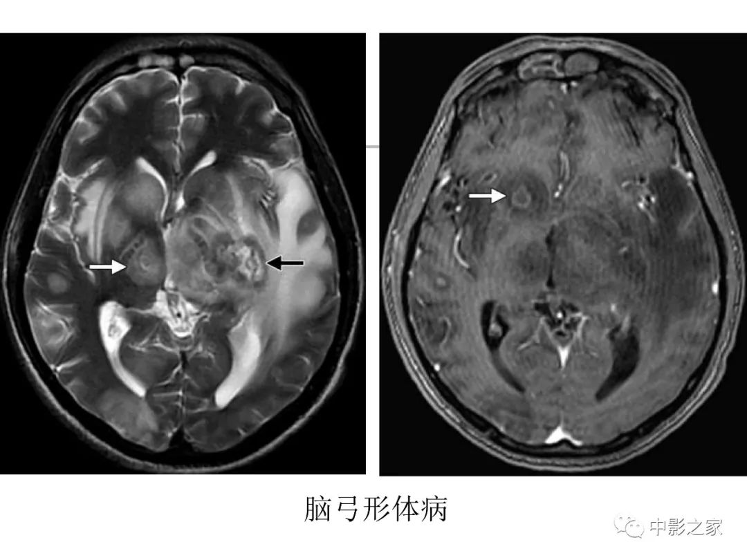 影像PPT - 【PPT】双侧基底节、丘脑病变影像学表现-62