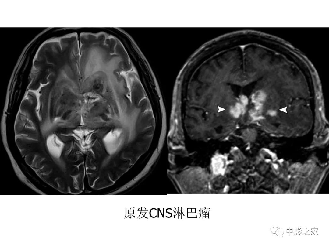 影像PPT - 【PPT】双侧基底节、丘脑病变影像学表现-64
