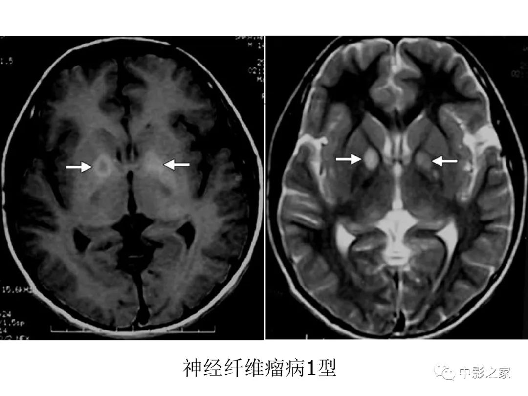 影像PPT - 【PPT】双侧基底节、丘脑病变影像学表现-68