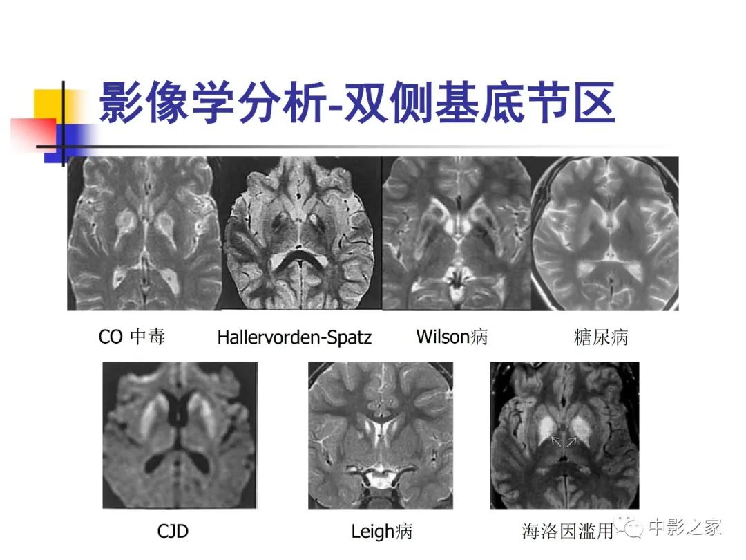 影像PPT - 【PPT】双侧基底节、丘脑病变影像学表现-69