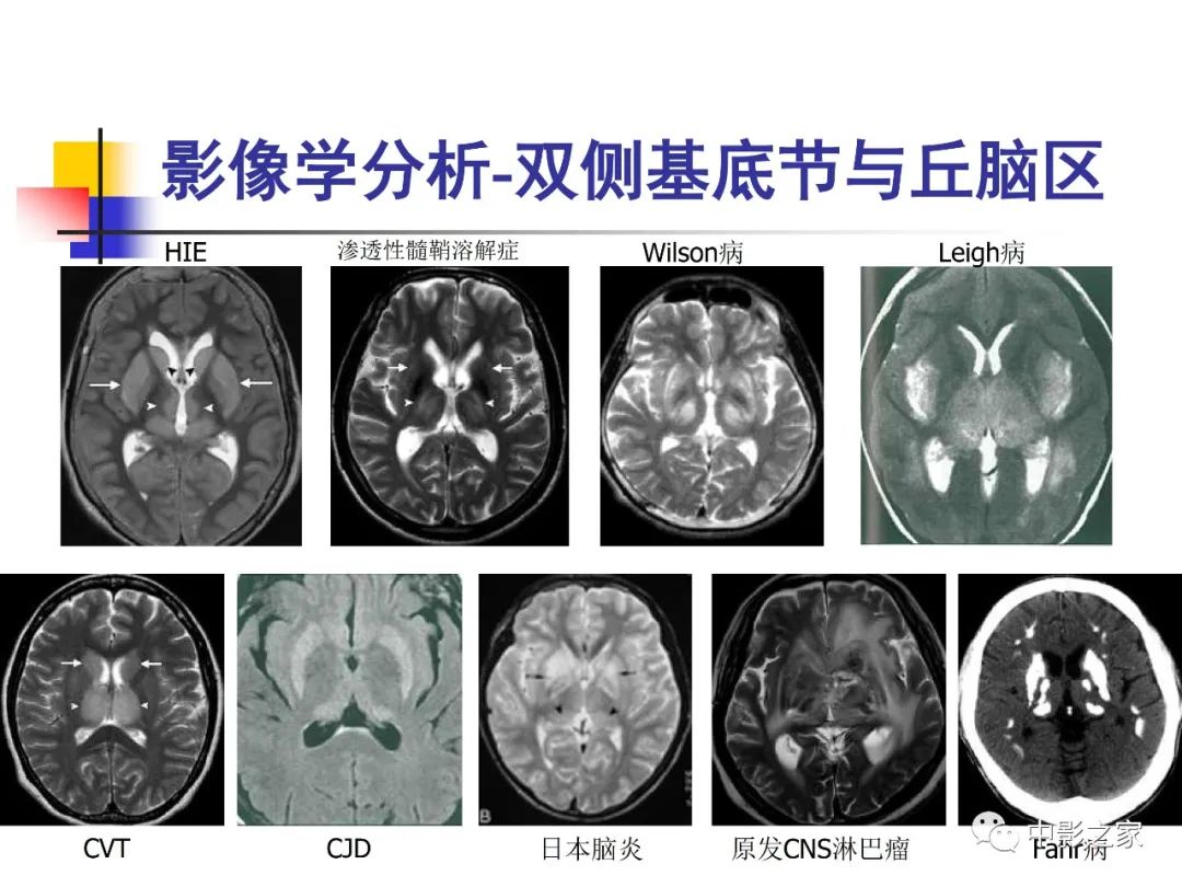 影像PPT - 【PPT】双侧基底节、丘脑病变影像学表现-70