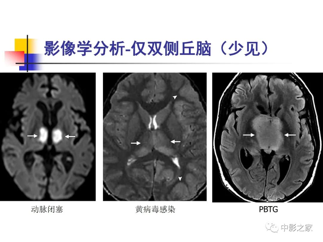 影像PPT - 【PPT】双侧基底节、丘脑病变影像学表现-71