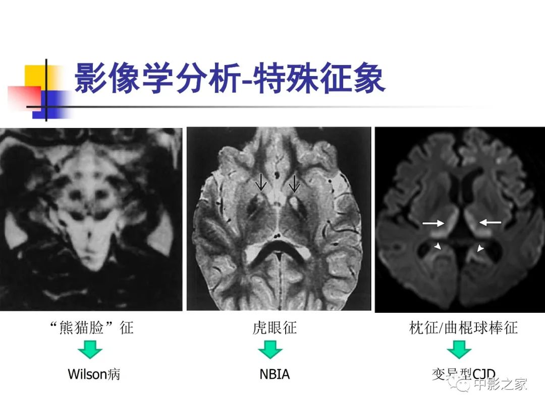 影像PPT - 【PPT】双侧基底节、丘脑病变影像学表现-72
