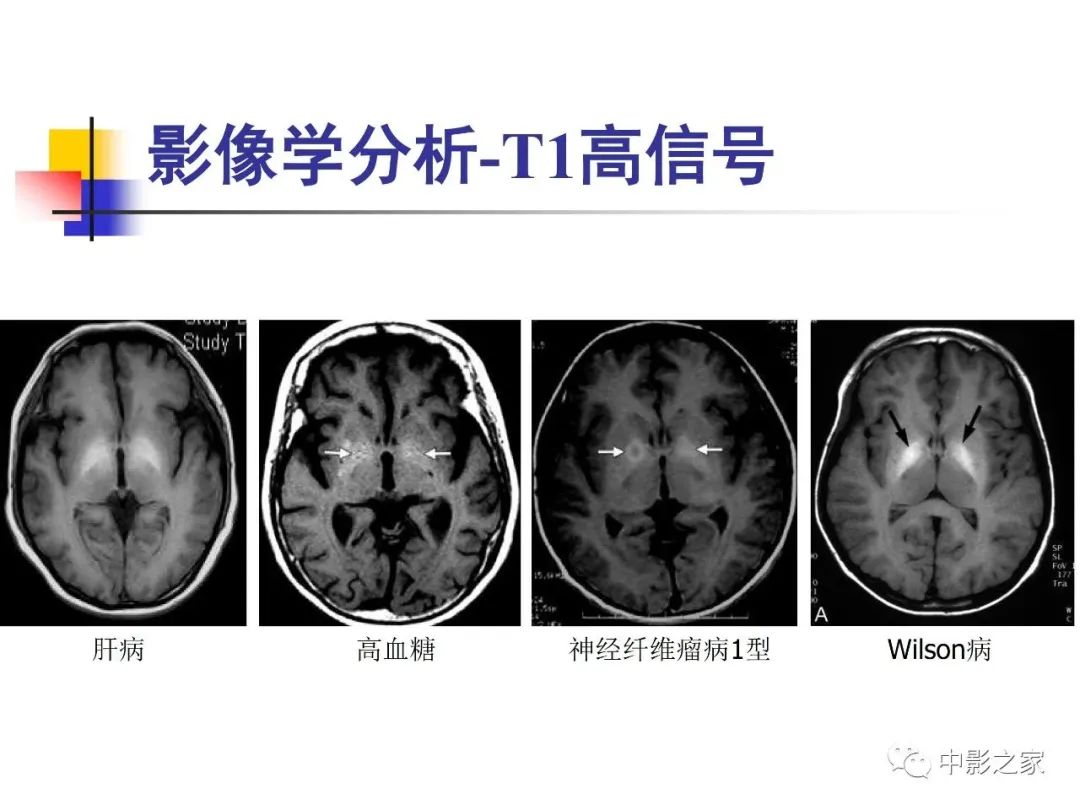 影像PPT - 【PPT】双侧基底节、丘脑病变影像学表现-73