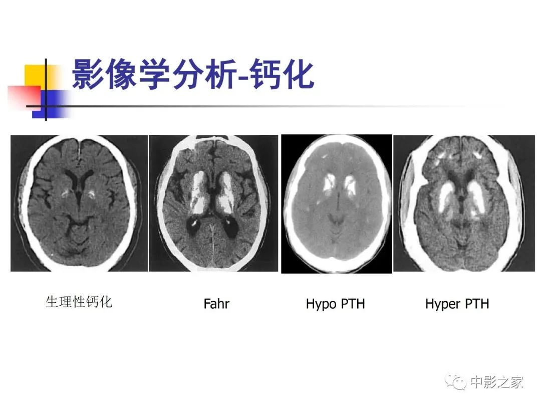 影像PPT - 【PPT】双侧基底节、丘脑病变影像学表现-74