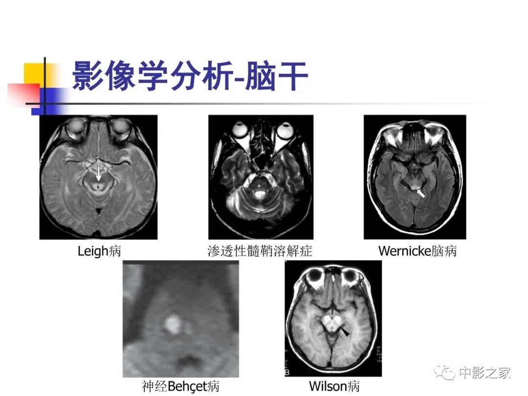 影像PPT - 【PPT】双侧基底节、丘脑病变影像学表现-75