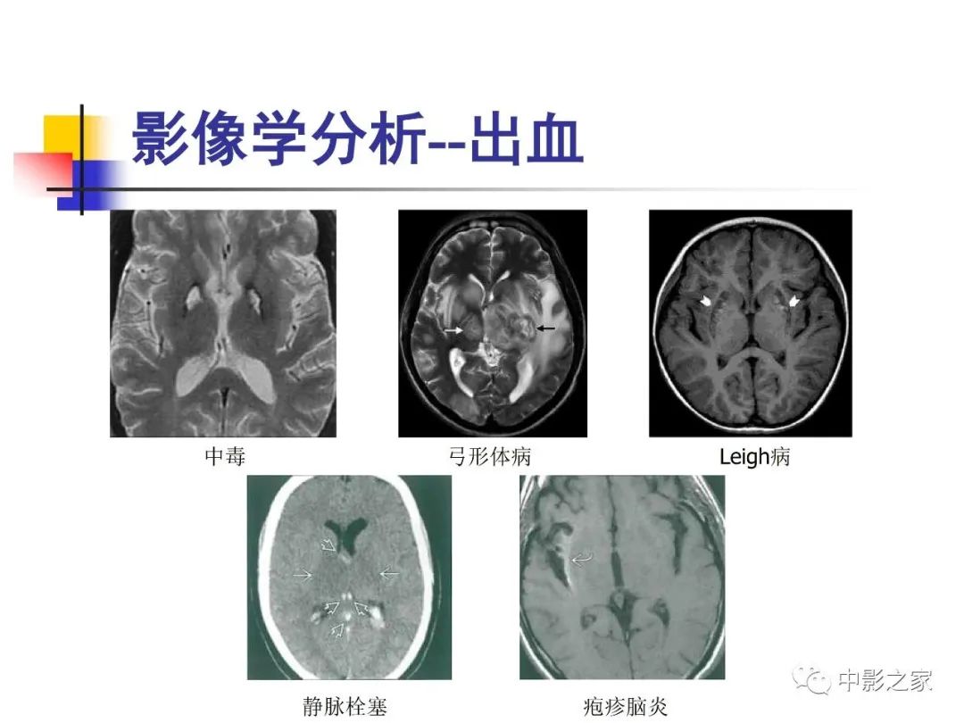 影像PPT - 【PPT】双侧基底节、丘脑病变影像学表现-76