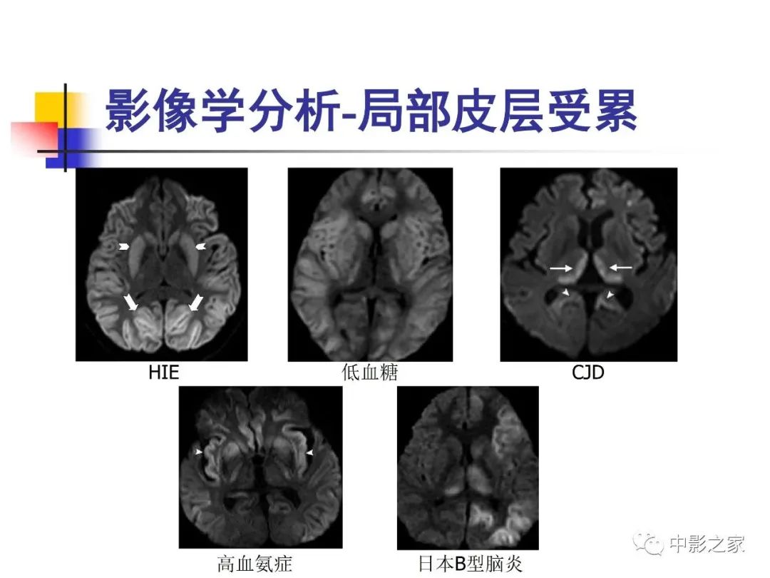 影像PPT - 【PPT】双侧基底节、丘脑病变影像学表现-77
