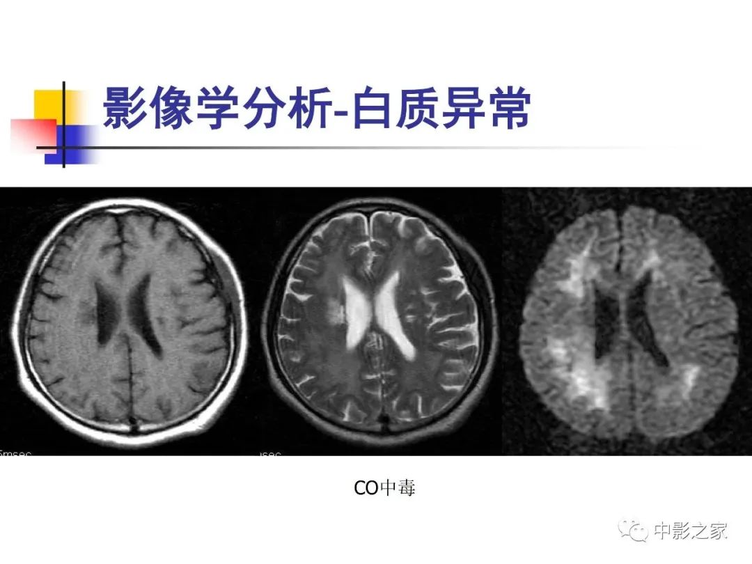 影像PPT - 【PPT】双侧基底节、丘脑病变影像学表现-78