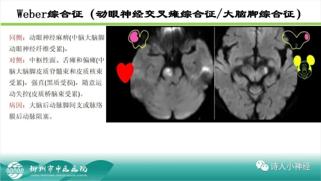 影像PPT - 【PPT】各种脑干梗死综合征临床解剖及影像-6