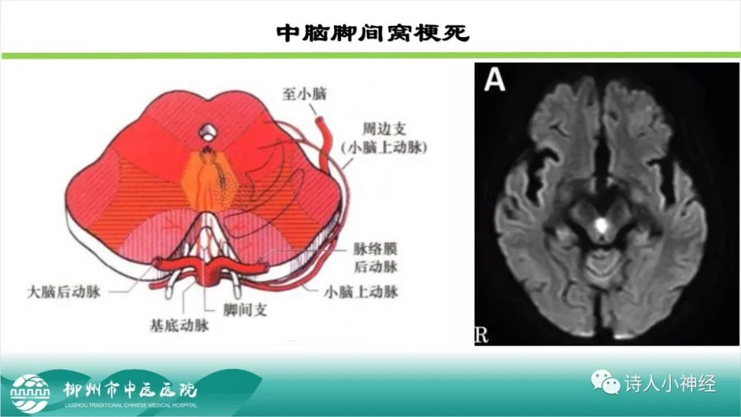影像PPT - 【PPT】各种脑干梗死综合征临床解剖及影像-7