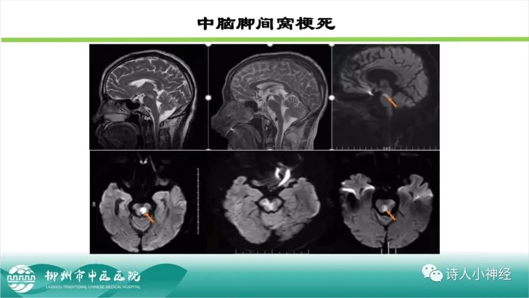 影像PPT - 【PPT】各种脑干梗死综合征临床解剖及影像-8