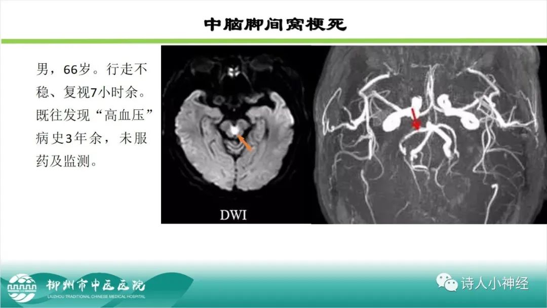 影像PPT - 【PPT】各种脑干梗死综合征临床解剖及影像-9