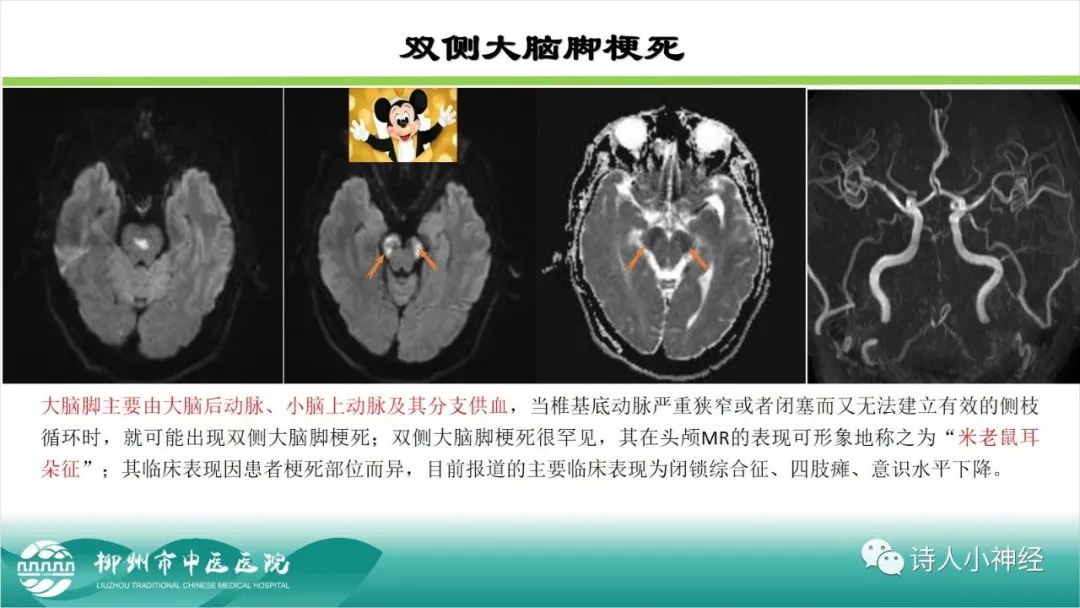 影像PPT - 【PPT】各种脑干梗死综合征临床解剖及影像-10