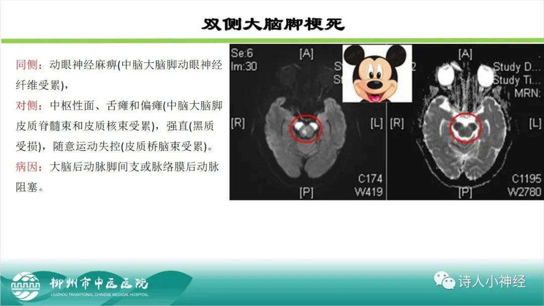 影像PPT - 【PPT】各种脑干梗死综合征临床解剖及影像-11