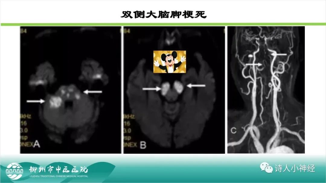 影像PPT - 【PPT】各种脑干梗死综合征临床解剖及影像-12