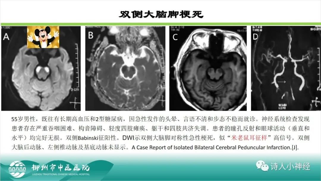 影像PPT - 【PPT】各种脑干梗死综合征临床解剖及影像-13