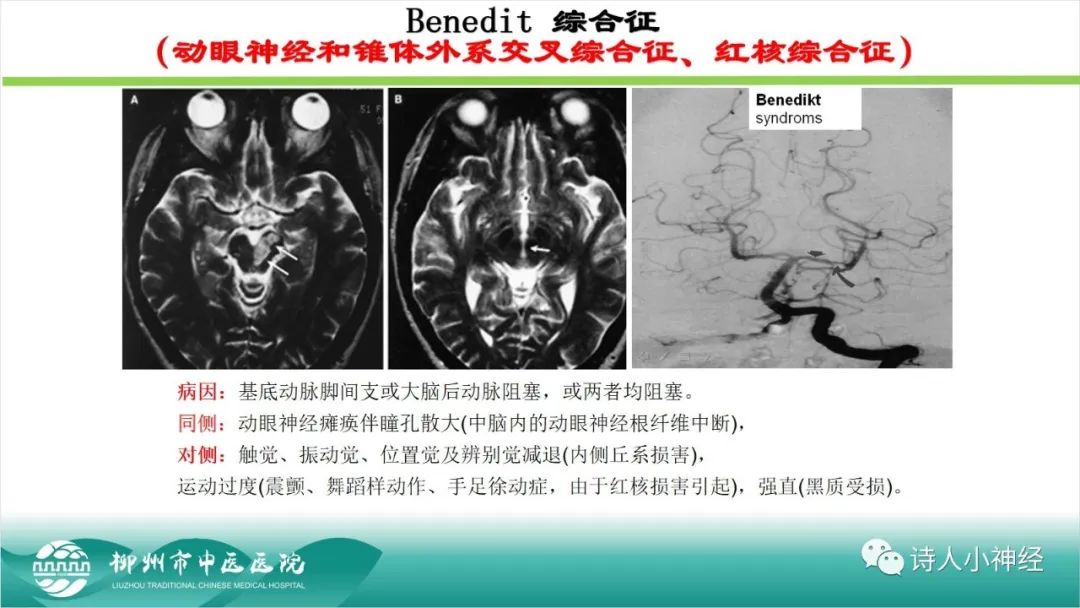 影像PPT - 【PPT】各种脑干梗死综合征临床解剖及影像-18